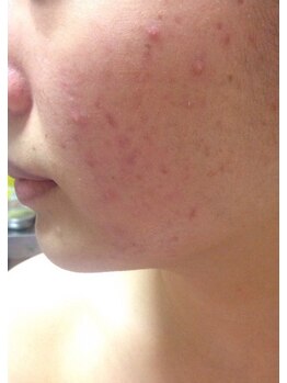 スキンケアスタジオ アコ 新宿店(Aco)/GP肌活２Dのお客様1ヶ月後