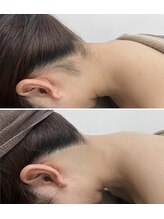 ミース 久留米店/うなじ脱毛体験1回目！