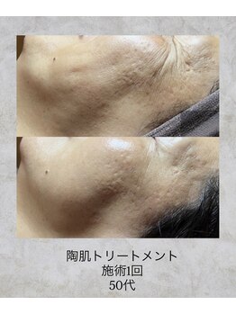 コンクパール(CONCH PEARL.)/陶肌トリートメント