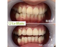 ルブラン 奈良店(Le Blanc)/簡単セルフホワイトニング