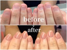 ネイルサロン オー(Oh!)/劇 的☆深爪矯正！Before→After