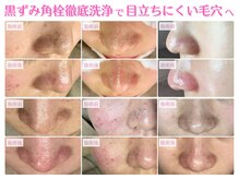 エステが初めて・機械マシーンが苦手大歓迎の毛穴ケア専門サロン