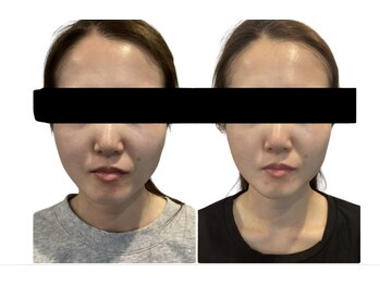 ルフレ(REFLET)/【事例4】Before/After乾燥肌