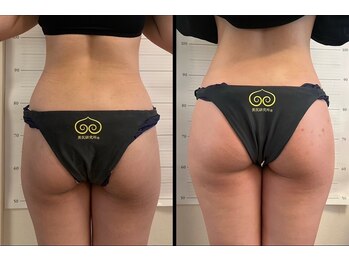 美尻研究所 銀座店/垂れ尻がヒップアップして美尻に