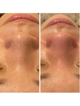 ラヴィ(La vie)/毛穴エクストラクション/毛穴