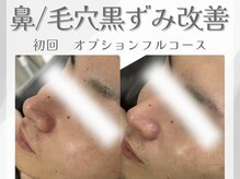 アン ネイル(ANN NAIL)/毛穴/ハーブピーリング