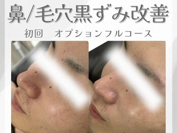 アン ネイル(ANN NAIL)/毛穴/ハーブピーリング