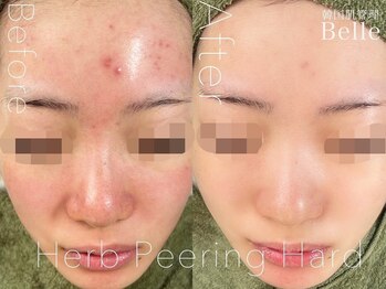 ベル 横浜(Belle)/ハーブピーリング｜ニキビケア