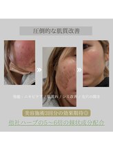 アムリリー 南草津店(AMRILY)/劇的肌改善