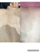 チャーム(CHARM∞)/背中トリートメント