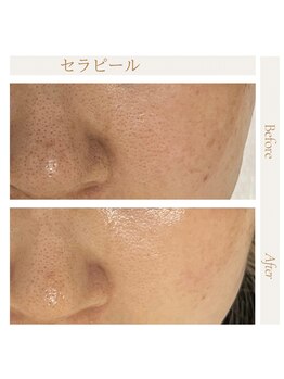 icca～大人の上質サロン～《韓国式セラピール/脱毛/毛穴洗浄/ネイル》大宰府店/セラピール