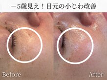 芯美 恵比寿店(shinbi)/目元ケアOptyl施術1回【恵比寿】