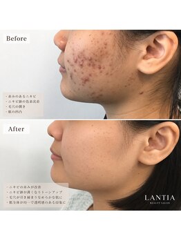 ランティア 大阪梅田南森町(LANTIA)の写真/≪大阪天満宮≫肌管理を毎月の習慣に★毛穴,ニキビ,美白を集中改善《結果重視の定額サブスク》¥11,000~♪