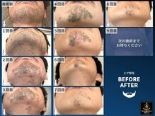 ロミオワックス ジュリエットワックス 新宿店(ROMEO Wax Juliet Wax)/メンズ★ヒゲ脱毛8回目経過写真