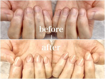 ネイルサロン オー(Oh!)/劇 的☆深爪矯正！Before→After