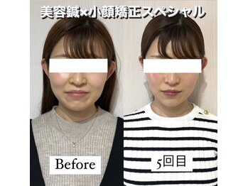 ハリカ 大阪心斎橋店(HARIKA)/他では味わえないカッサの爽快感