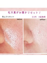 プライベートサロン 美月/毛穴開き・黒ずみ撃退！毛穴レス