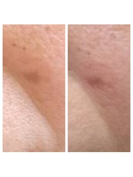 ワイエヌオリーブ(Y.N.Olive)/ほうれい線でお悩みの方必見!