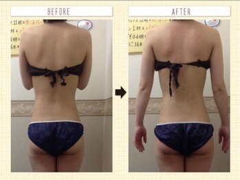 エステティックサロン ピュール ボーテ 東金店/ハイパーナイフ