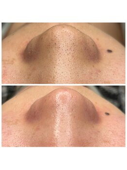 ジュエカフネ 広尾(JueCAFUNe)/フェイシャルで毛穴もバイバイ