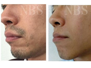 ブロンズ(BRONZE)/メンズ脱毛≪3回目≫