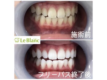 ルブラン 奈良店(Le Blanc)/本来の歯のお色へ!
