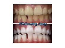 ホワイトニングショップ 船橋店/Before&After美白ホワイトニング