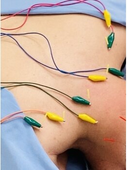 そら鍼灸整骨院/★鍼灸 電気鍼★