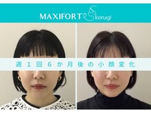 マキシフォート 名駅店(Maxifort)/週1回6ヶ月後の小顔変化