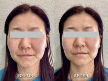 ワイ(Y)/一度でお顔の長さ短縮！！