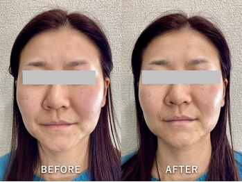 ワイ(Y)/一度でお顔の長さ短縮!!