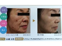 シエル/白玉スノーピール