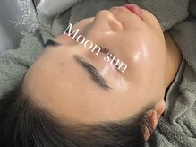 ムーンサン(Moon sun)/陶肌トリートメント