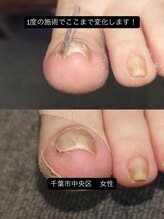 巻き爪じゅん 千葉駅前店/巻き爪の辛さに耐えてきた方へ