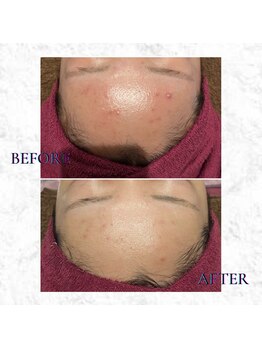 ビューティーマックス エースタジオ(Beauty MAX Astudio)/エンビロントリートメント