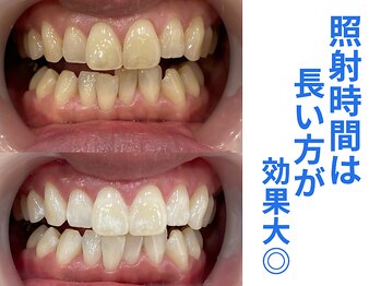 ホワイトニングカフェ 奈良新大宮店(WhiteningCafe)/◎歯のホワイトニング施術写真◎