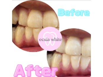 エクシアホワイトニング 可児店/ビフォーアフター