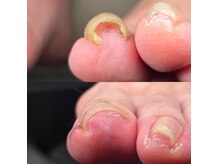 フットケア クラッシー(footcare classy)の雰囲気（1回の巻き爪ケアでここまで改善します！！）