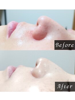 ララリア(LaLaLia)/光フェイシャル