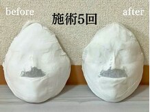 コルギサロン 伏見店(k_korugi.salon)/小顔コルギ　before after