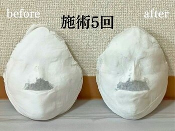 コルギサロン 伏見店(k_korugi.salon)/小顔コルギ　before after