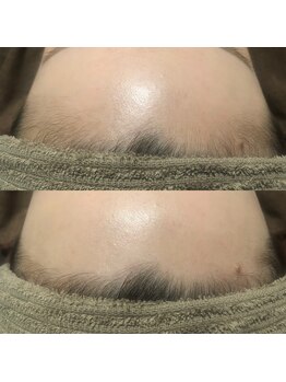 フォルチェ はません店(Folche)/顔の産毛/透明感/美肌/化粧ノリ