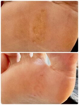 【角質ケア】魚の目・タコのケア