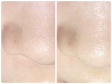 ラウン 京都(ROUN')/ EIEN1回の施術ビフォーアフター