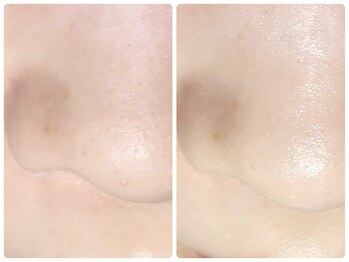 ラウン 京都(ROUN')/ EIEN1回の施術ビフォーアフター