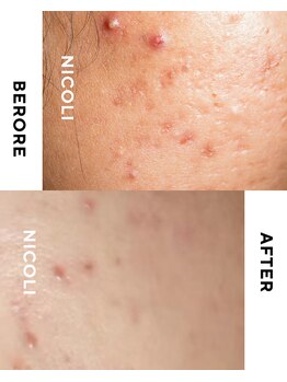 ニコリ(NICOLI)/ダメージ跡　長年の肌荒れ
