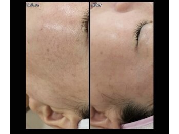 パールブルー(All Perl blue)/韓国白玉美肌ケア6回コース