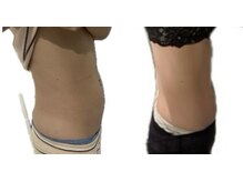 エステティックサロン ピュール ボーテ 東金店/ハイパーナイフ