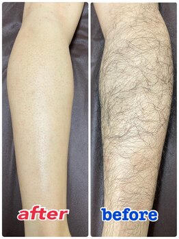 エステサロン桜/ひざ下ワックス脱毛