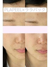 ドルチェナッツ ネオ 府内店(dolce nuts NEO)/プラピール＋ララパック♪